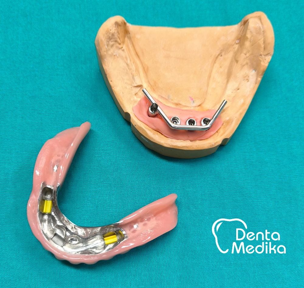 Třmenová hybridní náhrada na implantátech pro bezzubou čelist 4